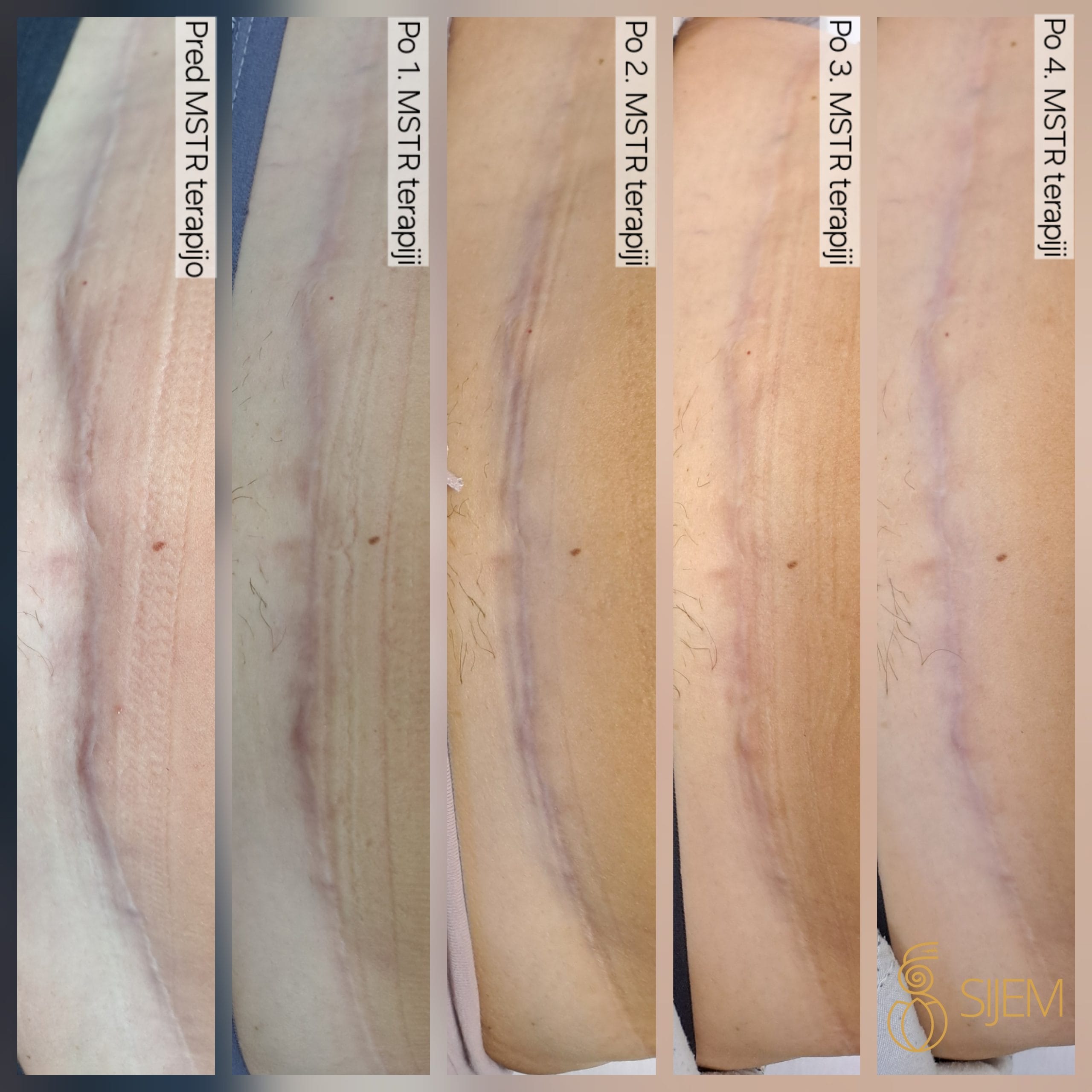 mstr-obravnava-brazgotin-abdominoplastika